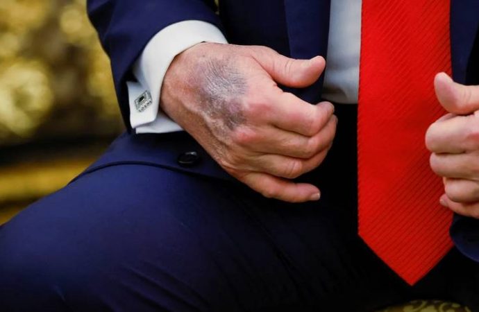 Trump’ın elindeki morluk neden: Beyaz Saray açıkladı
