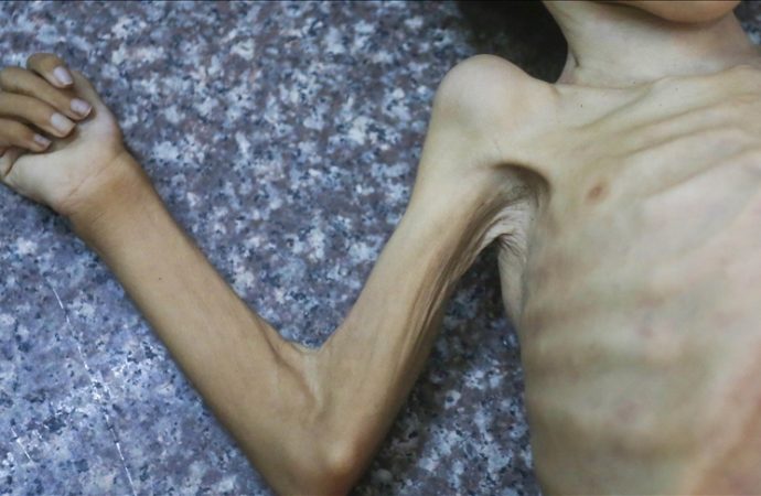 7 ekimden bu yana bilanço korkunç: Gazze’de 339 kişi açlıktan öldü