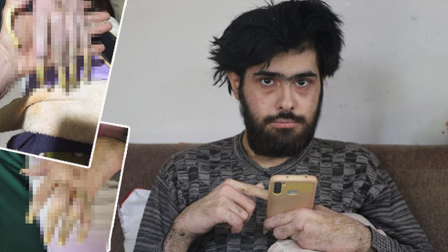 Hastasydı, deprem daha da hasta etti: 3 yıldır evden dışarı çıkmıyor