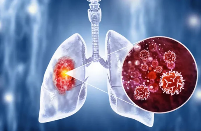 Son 5 yılda akciğer kanseri görülme sıklığı yüzde 15 arttı