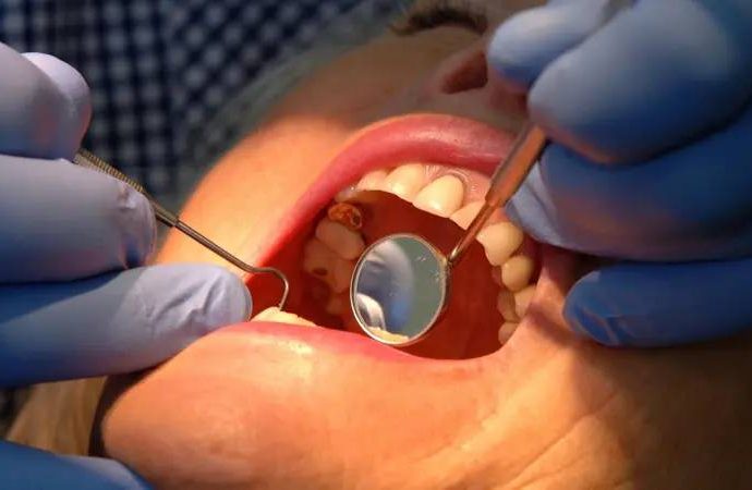 Diş minesini onaran yeni jel: Çürüklerin sonu mu geliyor?