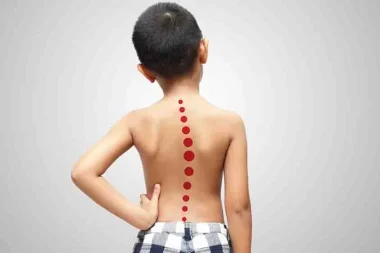 Skolyozda tedaviyi Cobb açısı belirliyor: ‘Ergenlikte hızla ilerleyebilir’