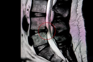 Bel fıtığı kâbus olmasın: Dokuz hayati önlem