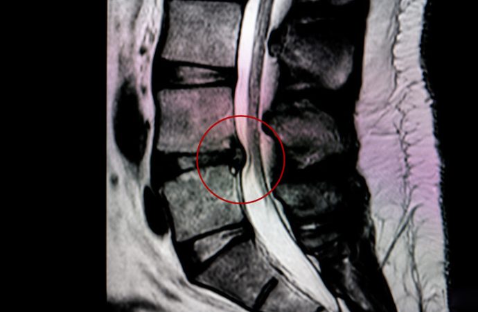 Bel fıtığı kâbus olmasın: Dokuz hayati önlem