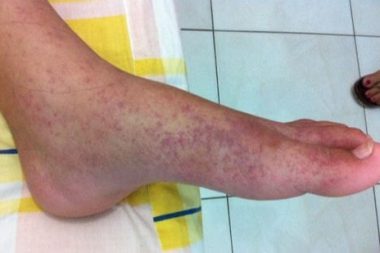 İklim krizi salgına yatak oldu: Asya’nın kaplan sivrisineği Avrupa’da