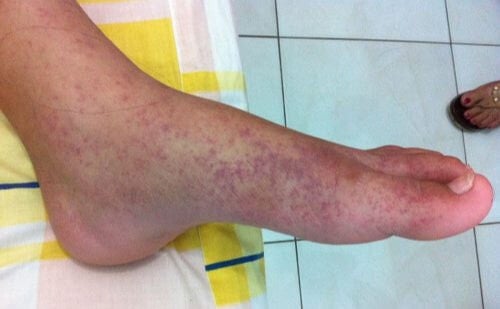 İklim krizi salgına yatak oldu: Asya’nın kaplan sivrisineği Avrupa’da