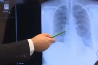 Kaplama dişleri uyurken akciğerine kaçtı