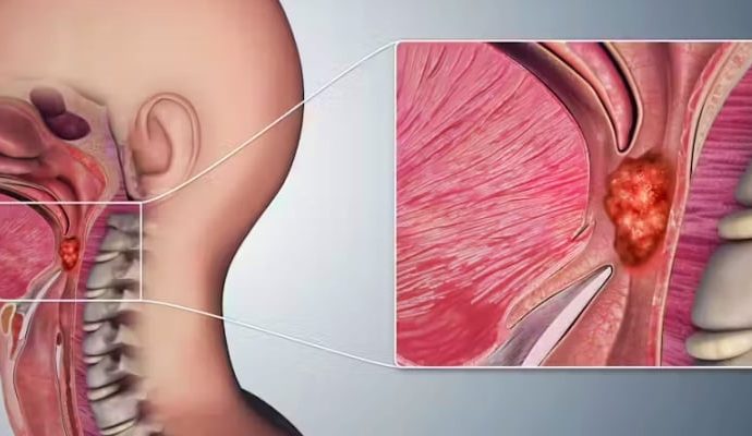 Kimin aklına gelir: Bir çeşit gırtlak kanserinin baş nedeni oral seks