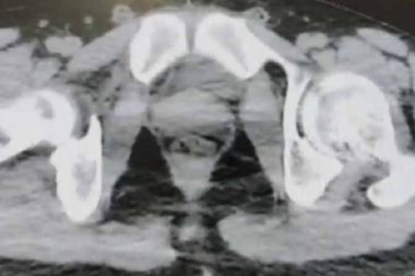 Metamfetamini yutarak kaçırıyorlardı: Bir kiloya yakın kapsülle yakalandılar